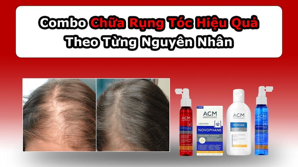 Sản Phẩm Trị Rụng Tóc ACM Hiệu Quả Theo Từng Nguyên Nhân