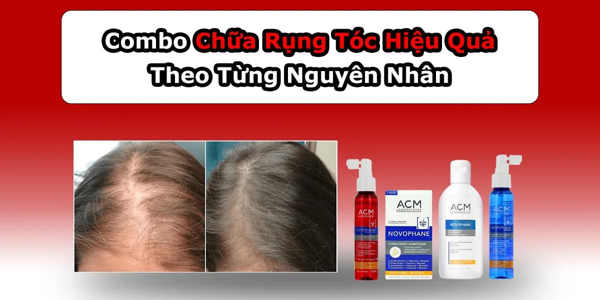 Sản Phẩm Trị Rụng Tóc ACM Hiệu Quả Theo Từng Nguyên Nhân