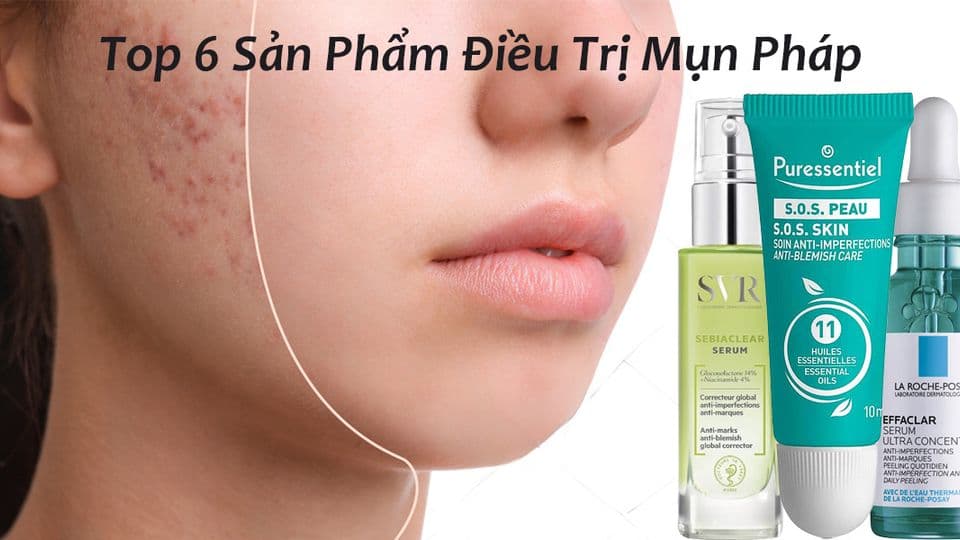 Top 6 Các Sản Phẩm Điều Trị Mụn Của Pháp Tốt Nhất