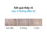 Kem Chống Nắng Ngừa Ung Thư Isdin Eryfotona AK-NMSC SPF 100+ Fluid