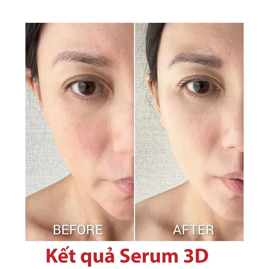 Kết Quả sử dụng serum Eucerin Hyaluron Filler Elasticity 3D