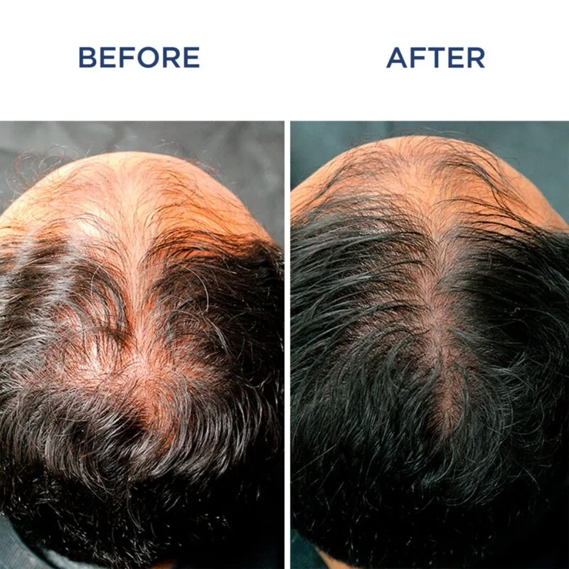 Kết quả trước và sau khi sử dụng Phyto Phytocyane Men