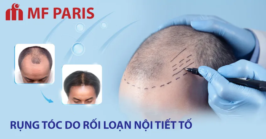 Rụng tóc liên quan thay đổi nội tiết