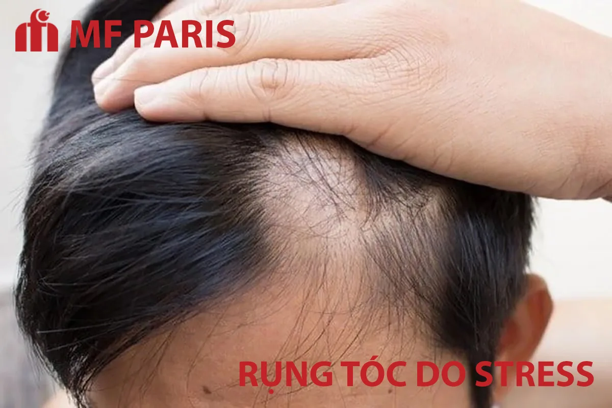 Căng thẳng có thể làm tóc rụng lan tỏa
