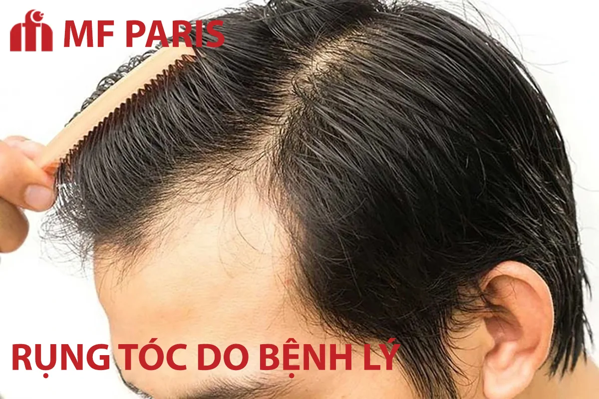 Bệnh da đầu có thể gây rụng tóc